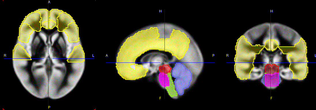 Amyloid_CorticalComposite